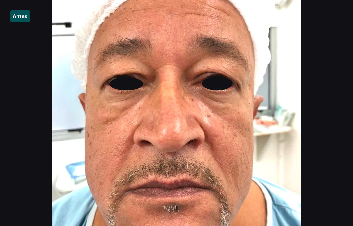 blefaroplastia 1-antes