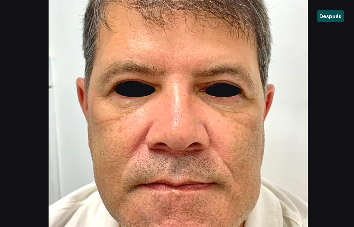 blefaroplastia 3-despues