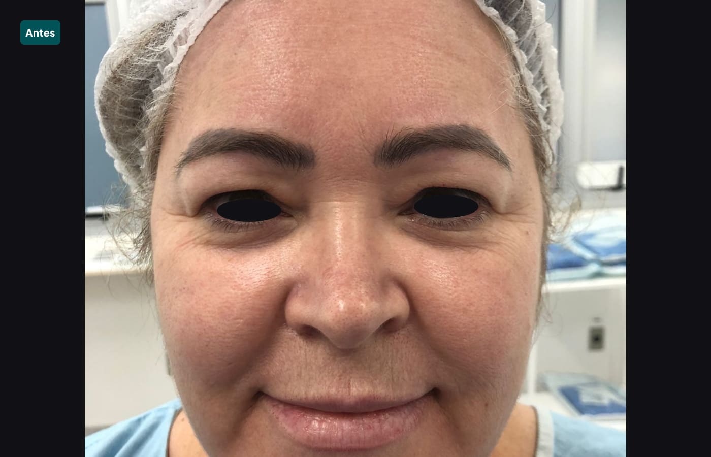 blefaroplastia 4-antes